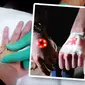  Seorang penggemar gadget dan karakter superhero Iron Man ini rela mengiris punggung tangannya agar punya chip yang bisa bersinar dari bawah kulitnya. (Sumber: YouTube (c) Bird Machine)