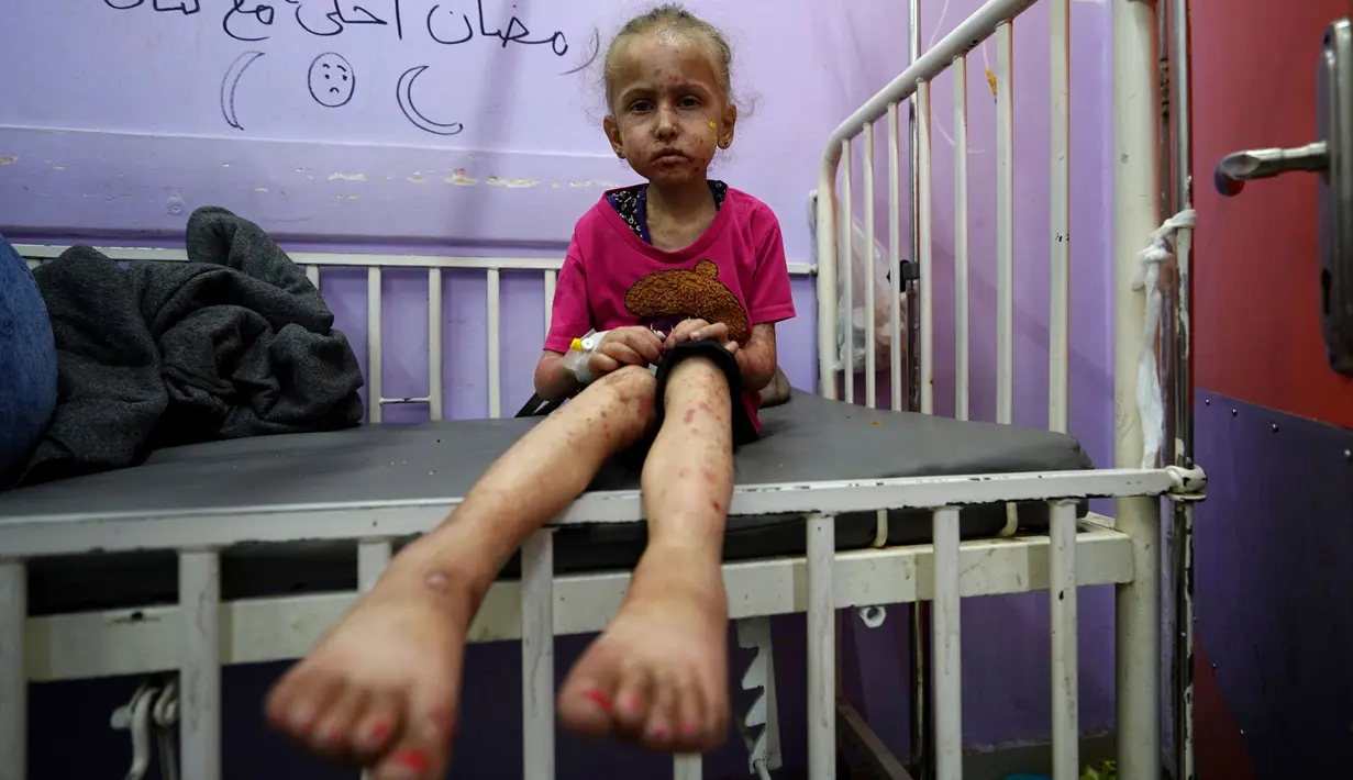 Dia mengatakan bahwa 1 dari 6 anak di bawah usia dua tahun mengalami malnutrisi akut di Gaza utara. (Bashar TALEB / AFP)
