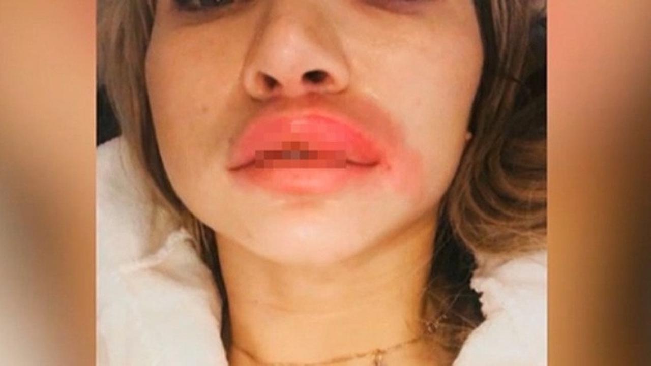 Lakukan Filler Murahan, Bibir Wanita Ini Bengkak Hebat