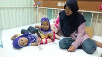 Kisah Kelahiran Kembar Siam Berkaki Tiga Asal Garut