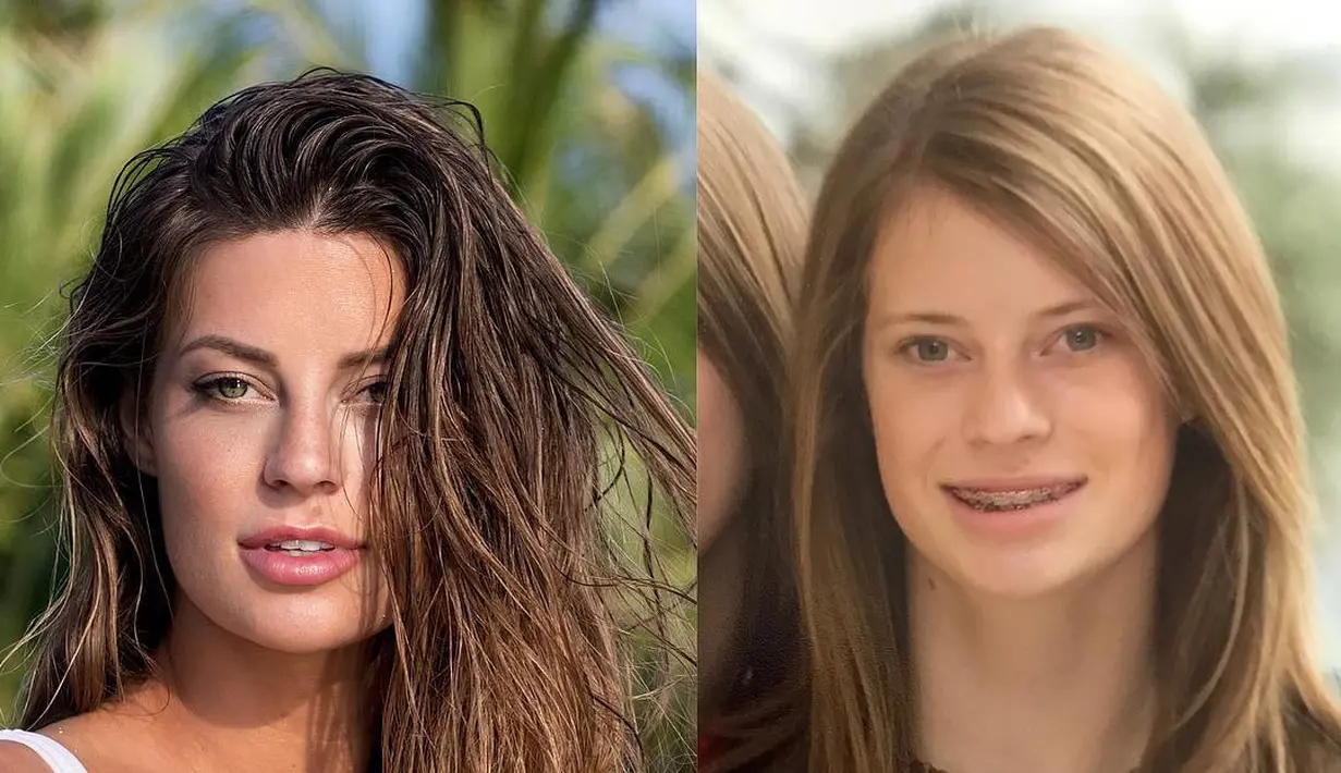 Miliki gigi yang nggak rata membuatnya harus memakai kawat hingga remaja. (instagram/hannahstocking)