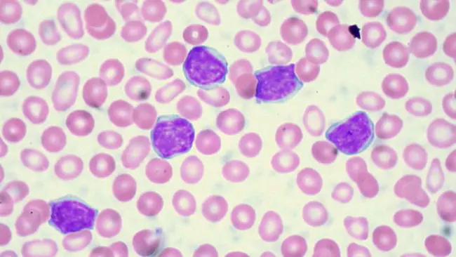 Leukemia. (Sumber Wikimedia Commons)