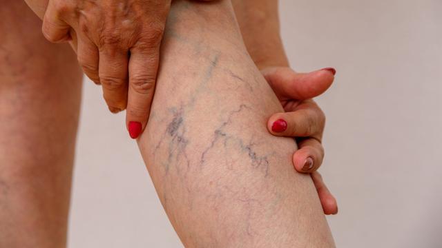 Dampak Buruk Varises Vena Jika Tak Dilakukan Terapi