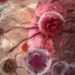 Ilustrasi sel kanker | Klikdokter