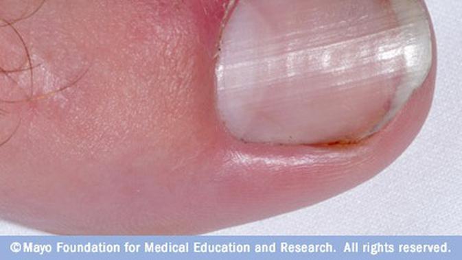 Paronikia Akibat Kuku Kaki Yang Tumbuh Ke Dalam Health Liputan6 Com