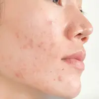 ilustrasi begadang menyebabkan jerawat/freepik