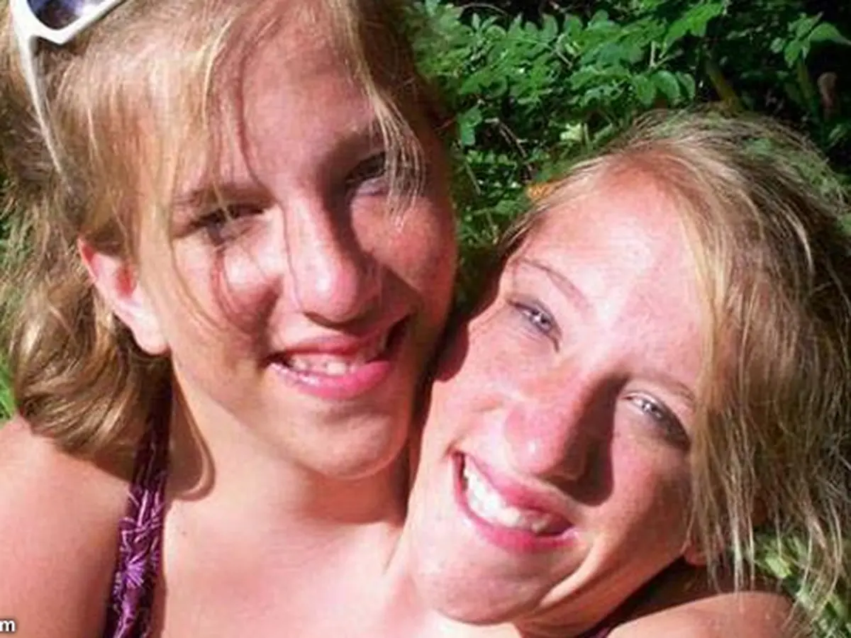 Kisah Kembar Abigail-Brittany: 1 Tubuh, 2 Kepala, 2 Gadis Berbeda - Global  Liputan6.com