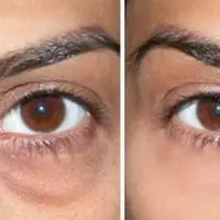 Sekarang kantung mata yang merusak penampilan kamu itu bisa segera menghilang…(Foto: YouTube.com)