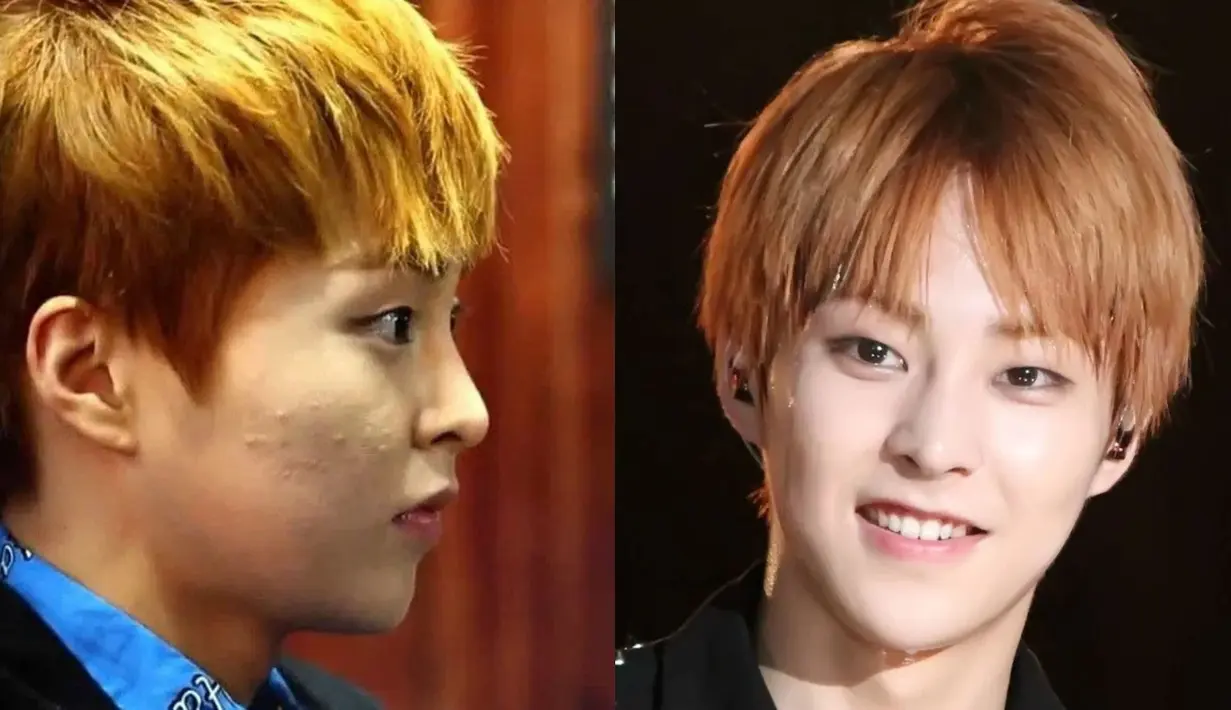 Wajah Xiumin EXO menjadi jerawatan karena terlalu sering mengenakan makeup. (Foto: koreaboo.com)