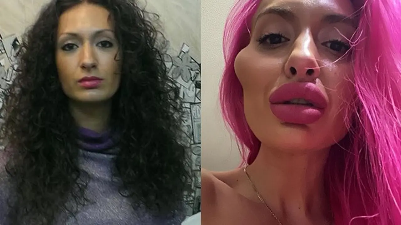 Lakukan Filler Pipi Sendiri, Wajah Wanita Ini Berubah Jadi Aneh