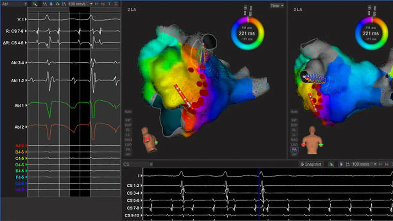 3D Mapping System Mudahkan Dokter Deteksi Gangguan Irama Jantung