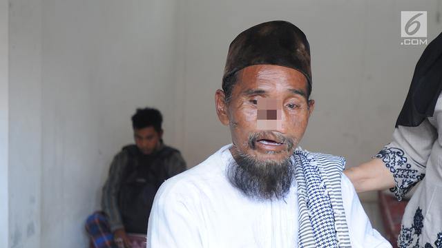 Viral Bermobil, Satpol PP Amankan Pengemis Tanpa Hidung di Bogor