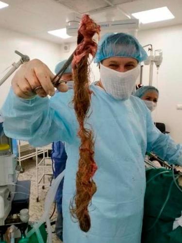 Mengeluh Sakit Perut, Dokter Temukan Kista Berisi Gumpalan Rambut dari Indung Telur Wanita Ini