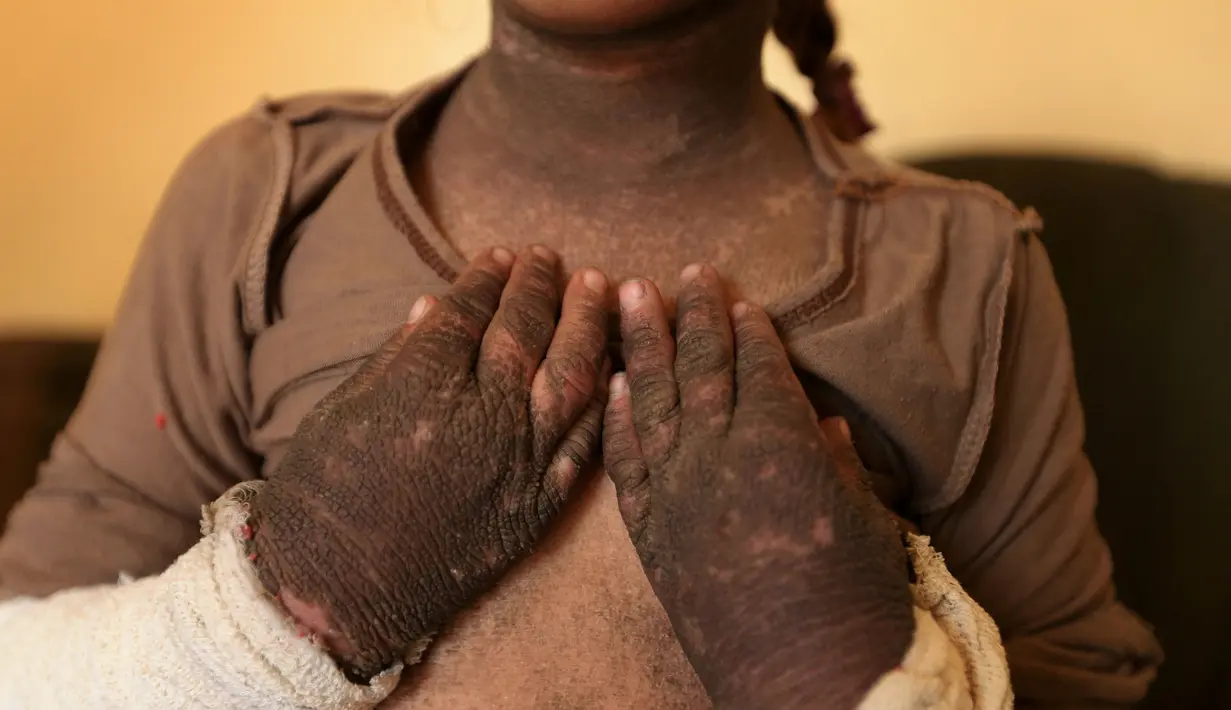 Doaa menunjukan kulit tangannya yang berubah akibat dampak bom kimia di Qayyara, Irak, (12/11). Pabrik kimia yang dibakar oleh ISIS selain memakan korban jiwa, anak-anak mengalami cacat pada kulit tubuh akibat radiasi asap. (REUTERS/Air Jalal)