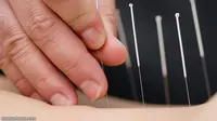 Akupuntur Perangi Kecanduan Kokain?