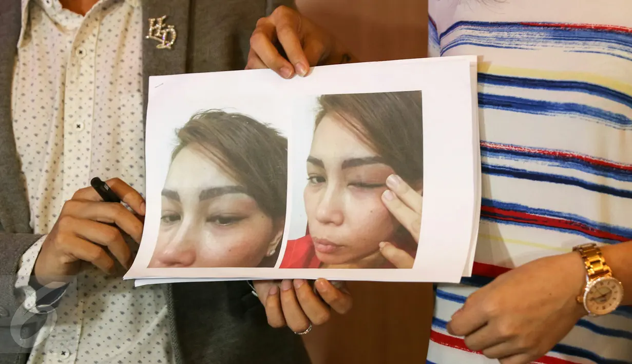 Istri Norman Kamaru, Cici Daisy Paindong menggelar konferensi pers terkait Kekerasan dalam Rumah Tangga (KDRT), Jakarta, Senin (15/2/2016). Cici menunjukkan bukti KDRT yang dialaminya. (Liputan6.com/Yoppy Renato)
