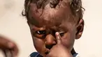 Seorang anak terlantar Suriah menggaruk matanya di kamp Washukanni untuk pengungsi internal selama bulan suci Ramadan di provinsi Hasakeh di timur laut Suriah, (10/5/2020). (AFP/Delil Souleiman)