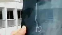 VIDEO: Gunting Tertinggal di Perut Pria Ini hingga Berkarat