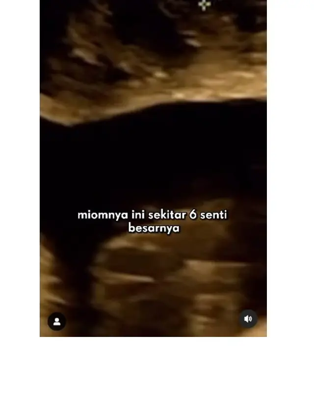 12 Potret Kondisi Alice Norin Usai Divonis Kanker Sarkoma, Terpaksa Menopause Dini