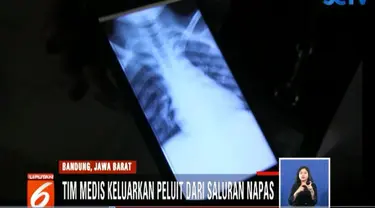 Peluit berukuran dua sentimeter yang bersarang di saluran pernapasan Asep sukses dikeluarkan lewat tindakan medis selama setengah jam.