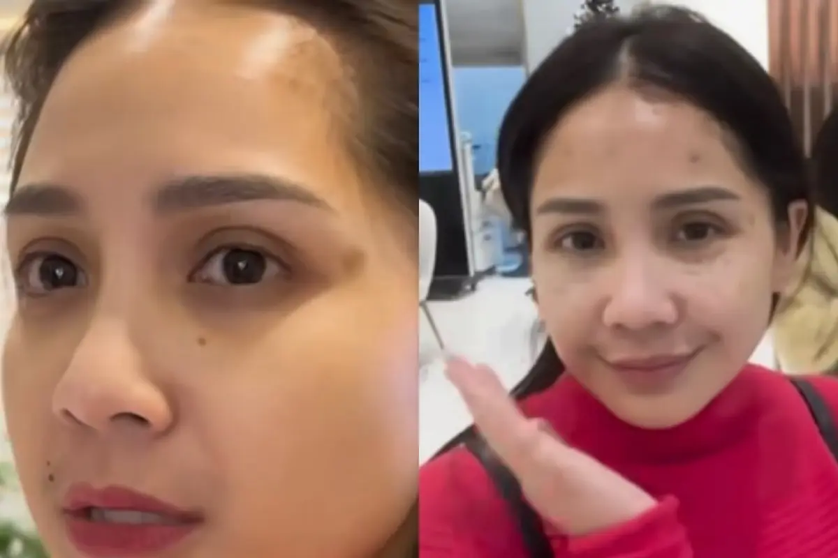 Wajah Bengkak Nagita Slavina Setelah Perawatan di Korea Selatan