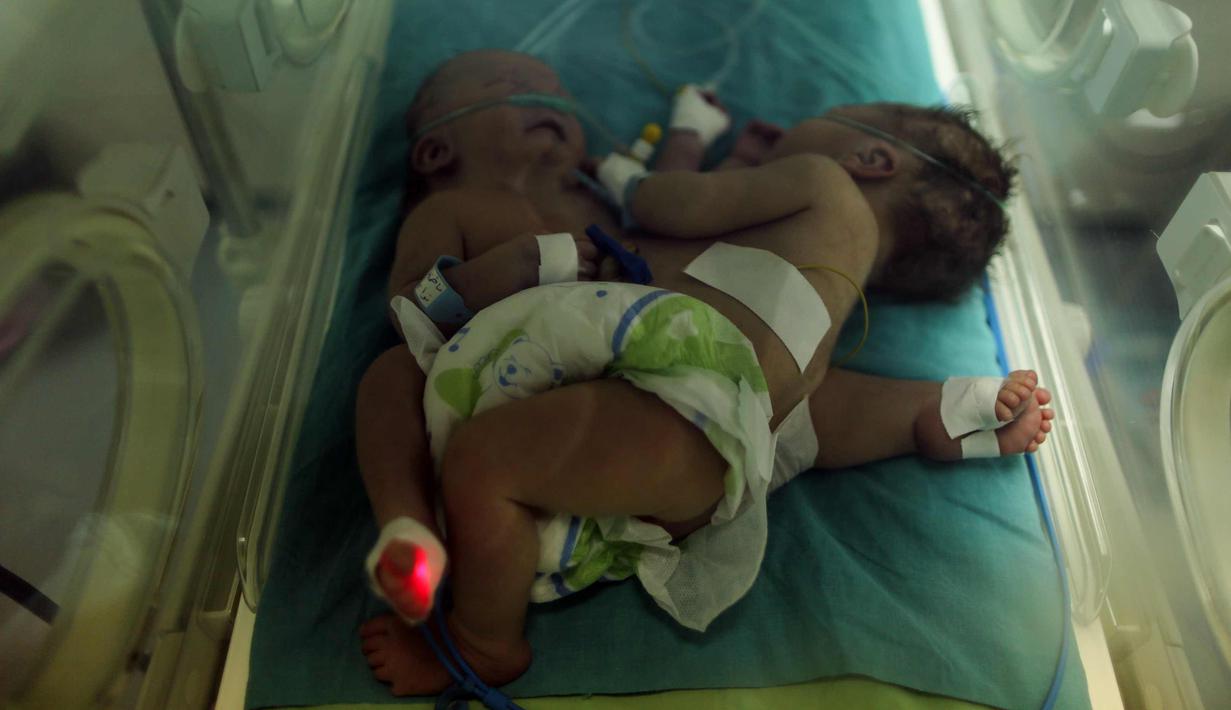 Bayi kembar siam berusia satu hari terlihat di dalam inkubator di Rumah Sakit al-Shifa di Kota Gaza, (22/10). Menurut Abu Hamda salah satu bayi tersebut memiliki satu kaki dimana telapak kakinya berdempetan. (AFP Photo/Mahmud Hams)