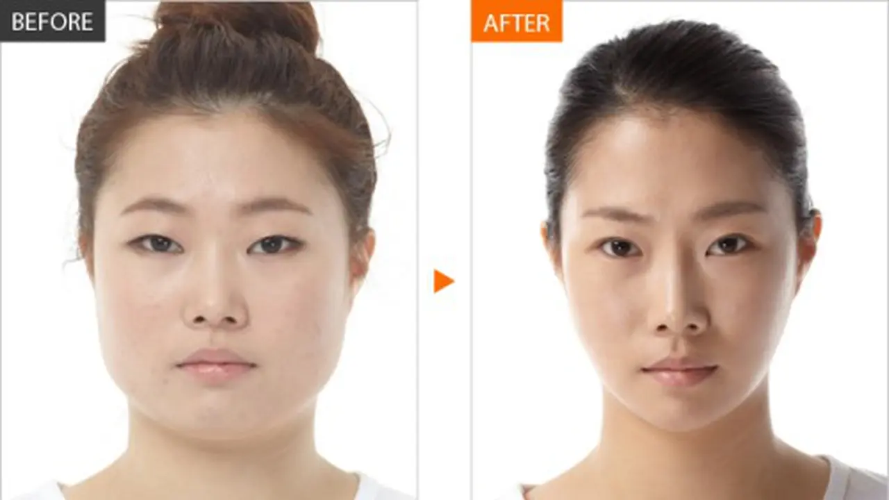 Korean Plastic Surgery