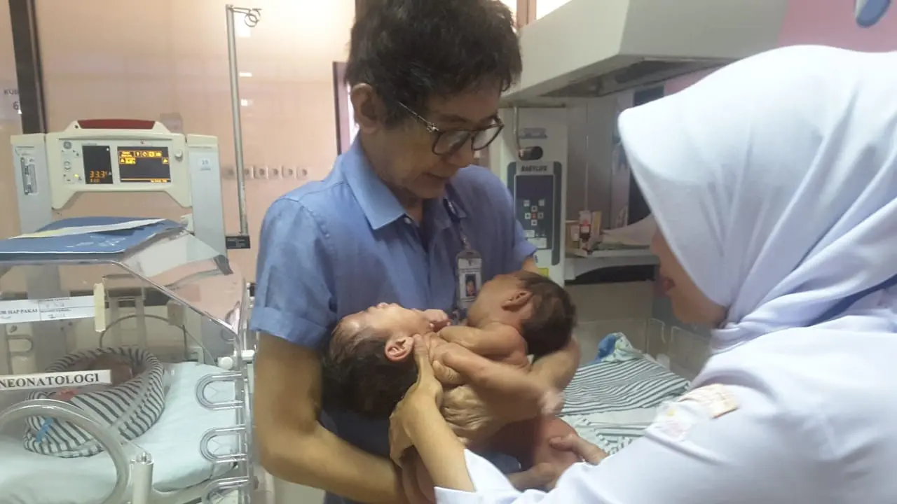 Ilustrasi bayi kembar siam