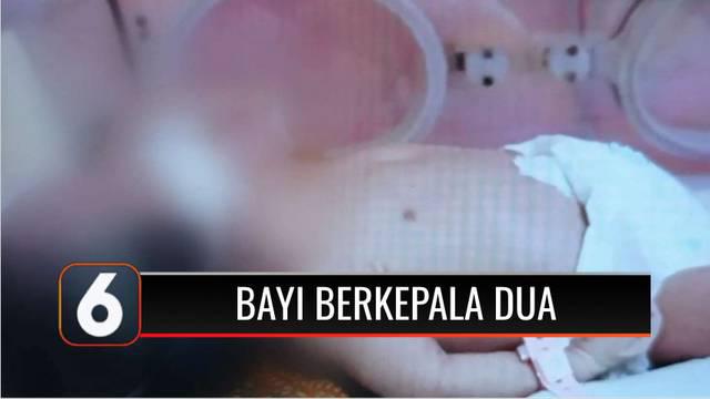 Seorang ibu di Kabupaten Tegal, Jawa Tengah, melahirkan bayi berkepala dua dengan satu tubuh melalui operasi caesar. Sang ibu dan bayinya masih menjalani perawatan di Rumah Sakit Dokter Soeselo Slawi, Kabupaten Tegal.