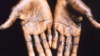 Monkeypox, infeksi virus langka mirip dengan cacar (Photo: CDC Public Health Image Library)