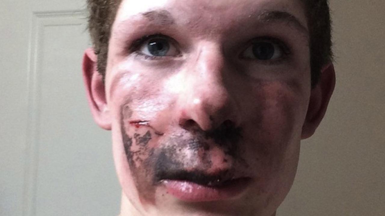 Karena Merokok Elektrik, Wajah Remaja Ini Terbakar 