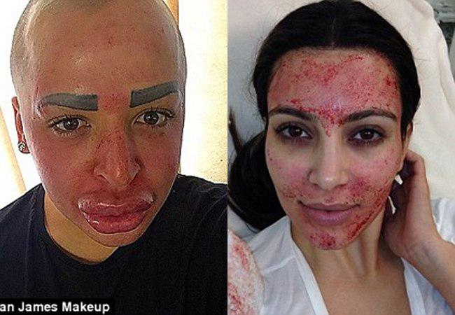 Parke juga melakukan masker darah seperti Kim | foto: copyright dailymail.co.uk