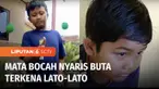Lato-lato belakangan memang digandrungi anak-anak. Namun demikian, ada saja sisi negatifnya. Di Kubu Raya, Kalimantan Barat, seorang bocah sampai harus dioperasi matanya karena terkena serpihan pecahan bandulnya.
