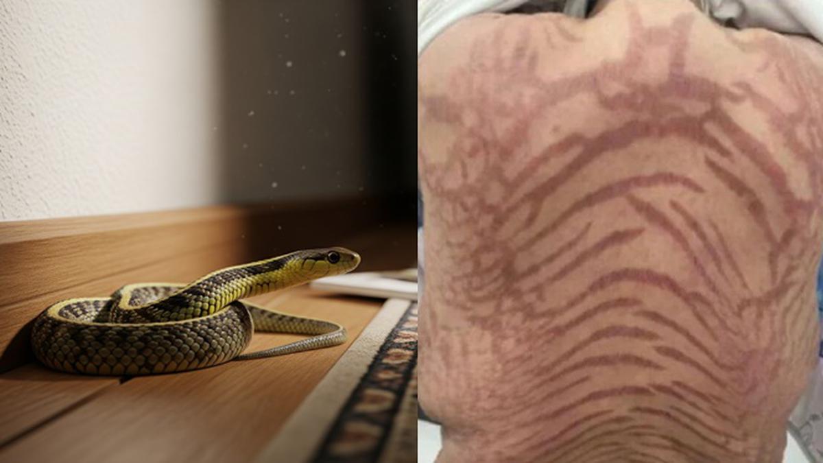 Wanita 40 Tahun Ini Alami Pola Kulit Mirip Ular Usai Pakai Salep Tradisional