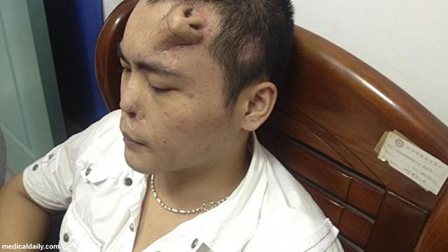 Hidung Pria Di China Tumbuh Di Dahi Global Liputan6 Com