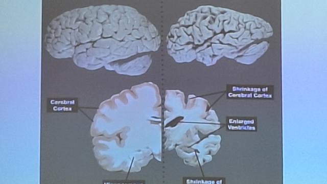 Healthy Brain vs AD Brain
