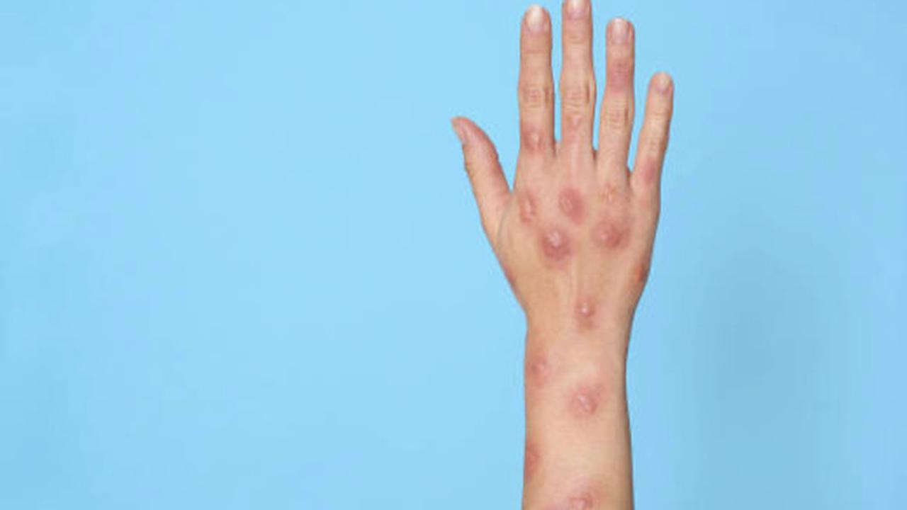 Vaksin seperti JYNNEOS dan ACAM2000 telah diharapkan memberikan perlindungan