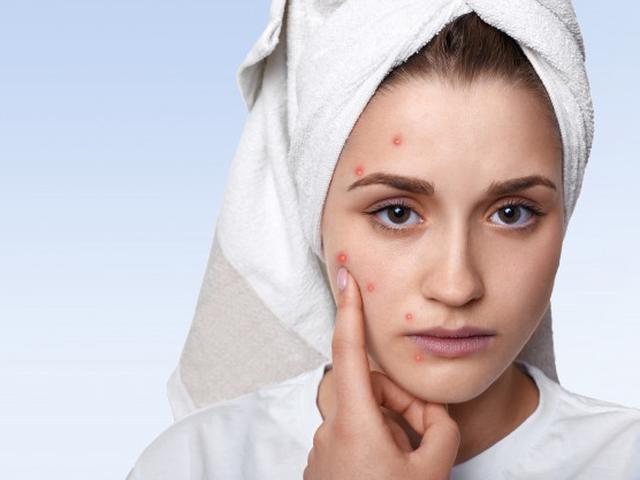 19 Cara Menghilangkan Bekas Jerawat Hitam Aman Dengan Bahan Alami Hot Liputan6 Com
