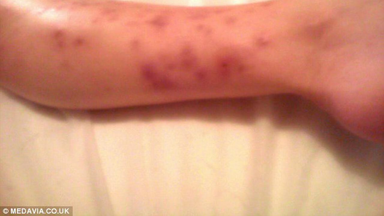 Digigit Laba-Laba, Kulit Carol Jadi Seram