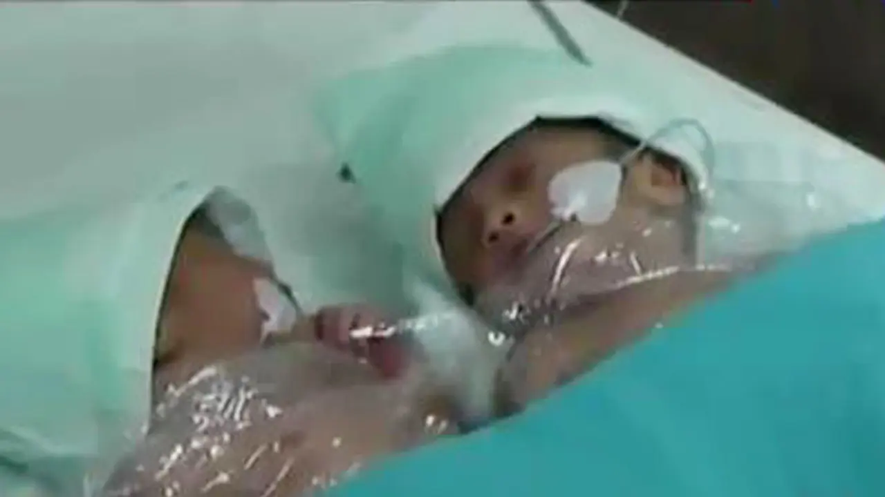 Bayi Dempet