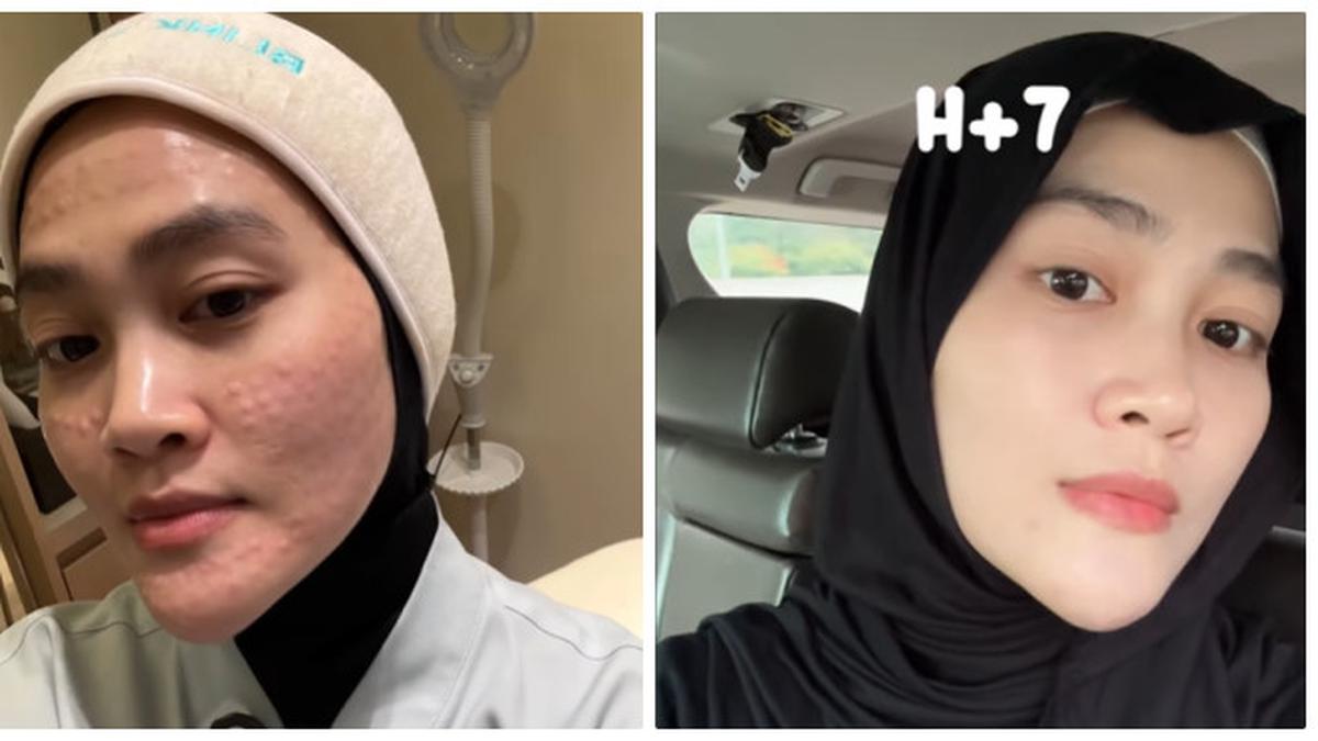 6 Potret Perubahan Wajah Henny Rahman Setelah Perawatan, Makin Cerah dan Mulus