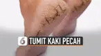 Tumit kaki pecah-pecah bisa disebabkan perubahan hormon. Serta faktor lingkungan bahkan beberapa hal lain.