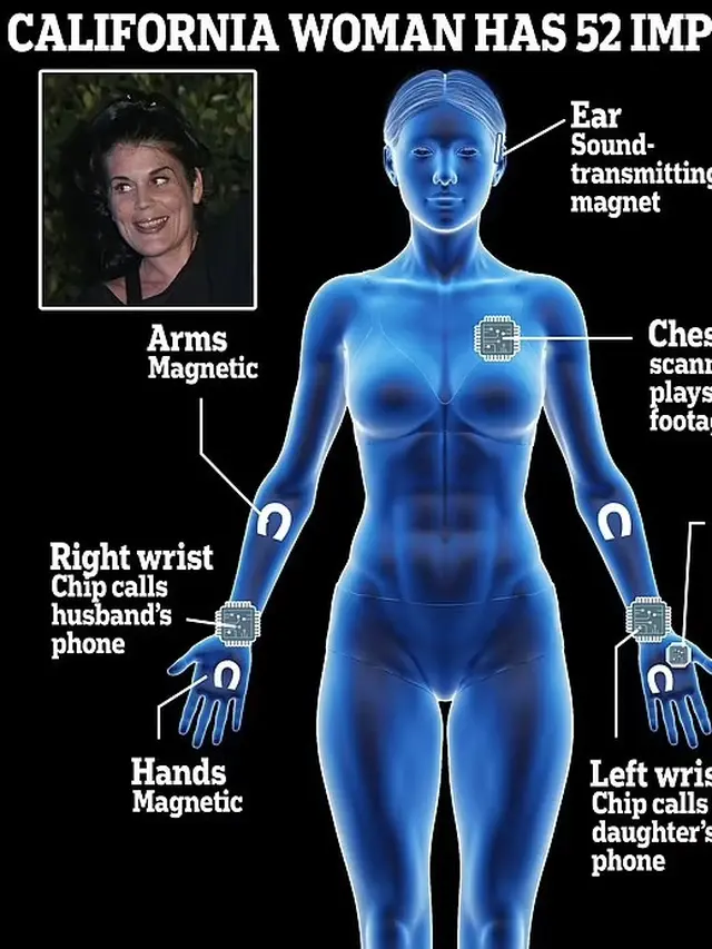 Wanita dengan 52 Implant Pecahkan Rekor Dunia