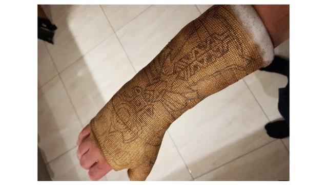 Pergelangan Tangannya Cedera, Pria Ini Gunakan Hiasan Gips yang Unik