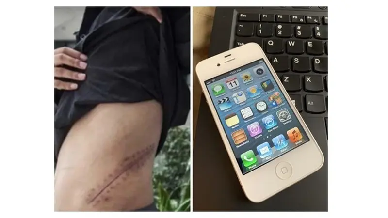 Kisah Remaja yang Rela Jual Ginjal Demi Beli iPhone Ini Bikin Pilu