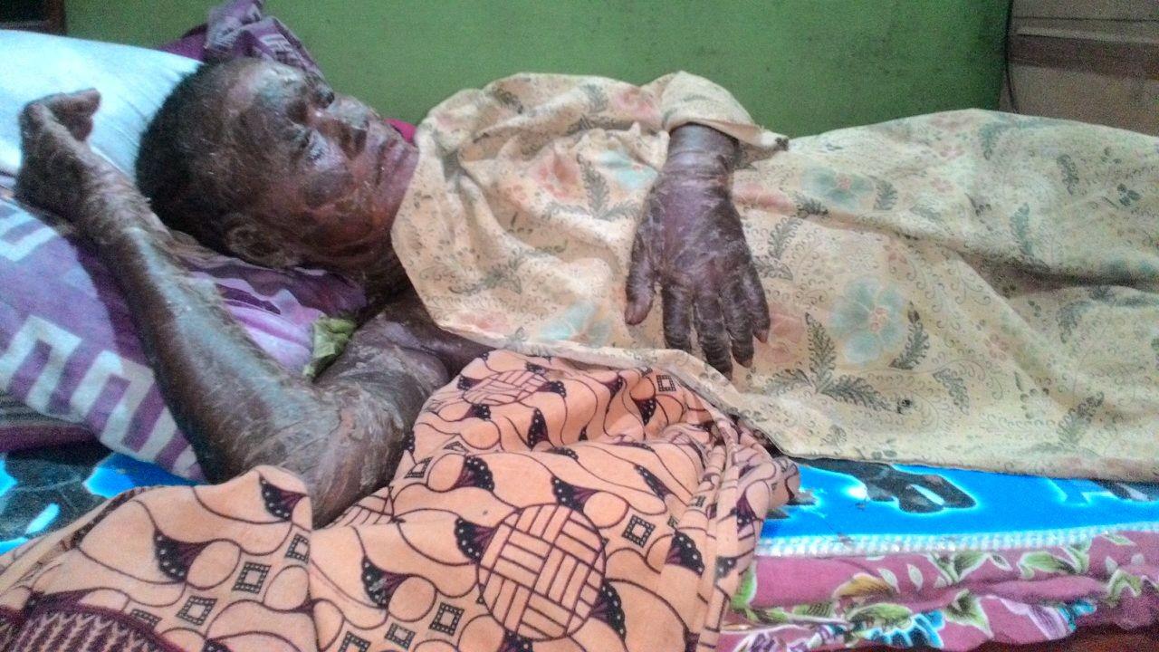 Kulit Warga Brebes Melepuh Sekujur Tubuh Hingga Menghitam