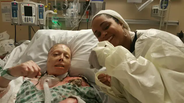 [Bintang] Karena Sang Mantan Pacar, Perempuan Ini Harus Menjalani 56 Kali Operasi