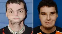 Pada 1997 silam, wajah Richard terkena lesatan peluru saat suatu insiden latihan tembak-menembak. 