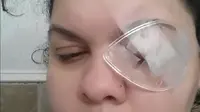 Serpihan glitter merusak kornea matanya hingga menyebabkan infeksi dan kebutaan pada mata kiri Erica. 