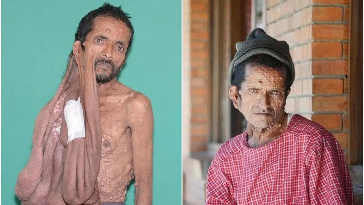 Operasi Sukses, Pria dengan Tumor Wajah Seperti Dilahirkan Lagi